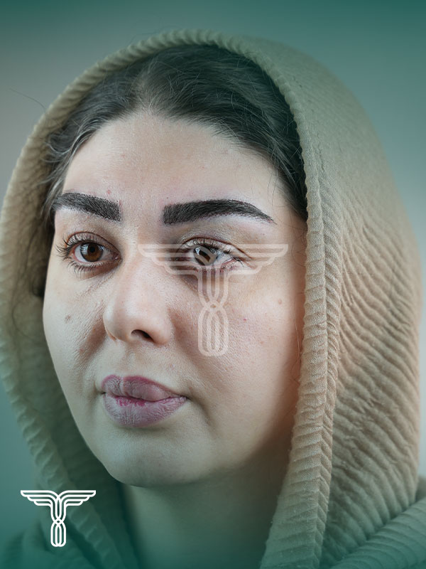 کاشت ابرو بعد