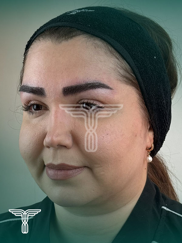 کاشت ابرو بعد