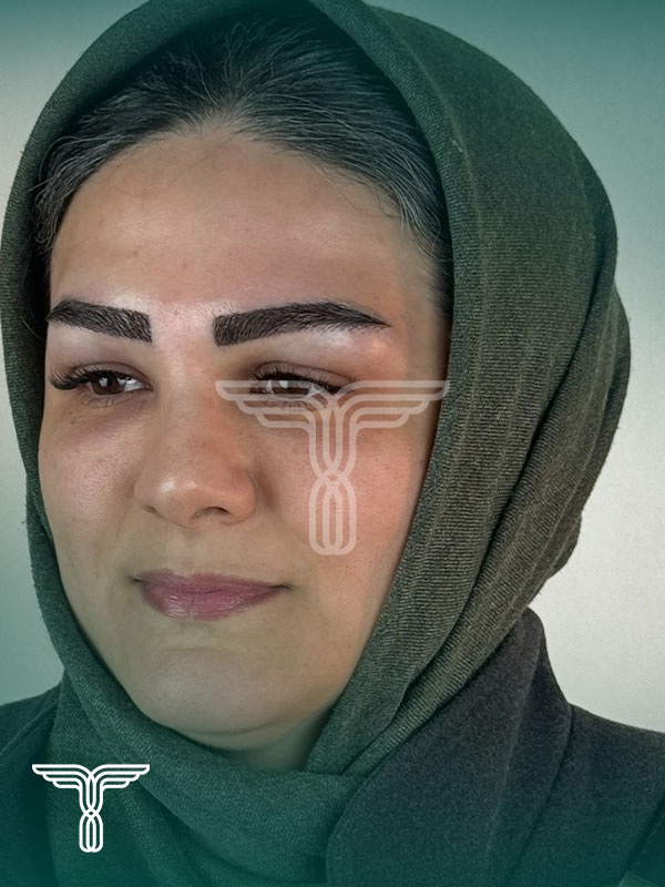 کاشت ابرو بعد