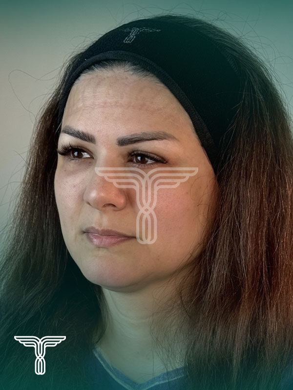 کاشت ابرو قبل